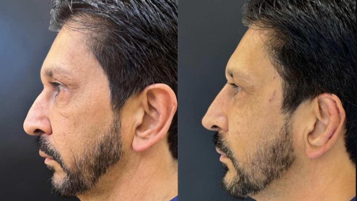 Prefeito terá de passar por manutenção a cada seis meses para a toxina botulínica /Foto: JK Estética Avançada/Divulgação