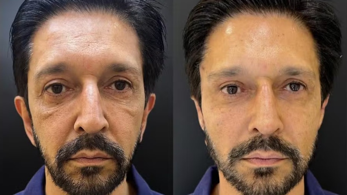 Ricardo Nunes (MDB) realizou uma harmonização facial na JK Estética Avançada /Foto: JK Estética Avançada/Divulgação