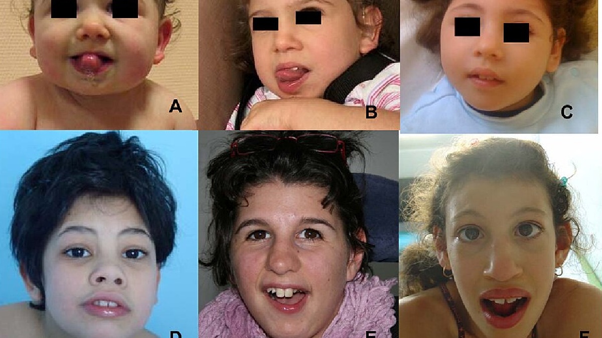 Por que algumas doenças genéticas são tão raras? A maioria das mutações nos genes não geram nenhuma mudança. Porém algumas combinações genéticas, como as hipoplasias pontocerebelares, são tão raras e tão catastróficas que a ciência ainda investiga qual são as relações de causa-efeito. Imagem: Orphanet Journal of Rare Diseases/Wikimedia Commons