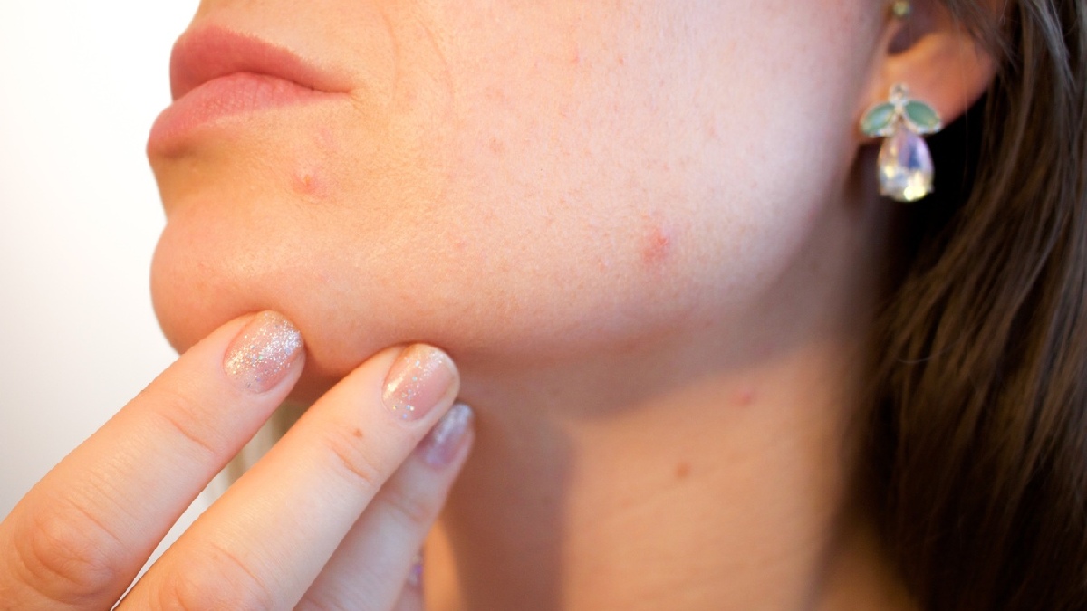 Acne pode aparecer por diversos motivos, muitos deles bastante simples de corrigir. Imagem: PxHere