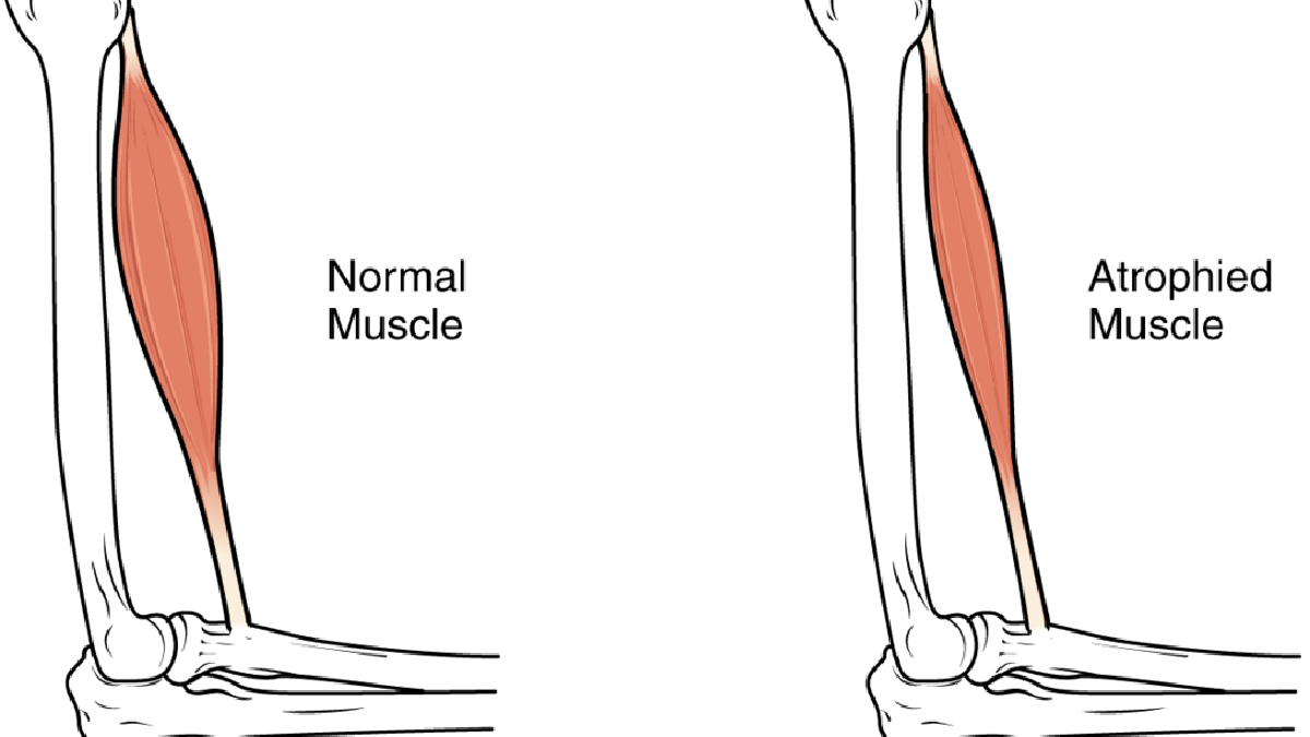 Esquema da sarcopenia, condição que atrofia os músculos conforme a idade avança. Imagem: OpenStax/Wikimedia Commons