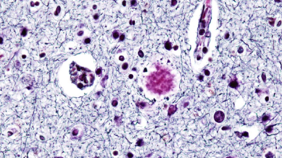 Alzheimer é causado pelo acúmulo de placas de proteína nas células cerebrais. Imagem: User:KGH/Wikimedia Commons