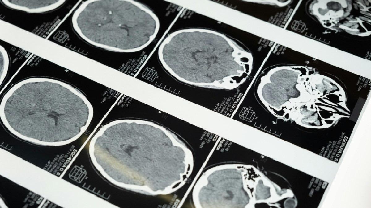 Cientistas analisaram mais de 12 mil exames de ressonância do cérebro. Imagem:cottonbro studio/Pexels