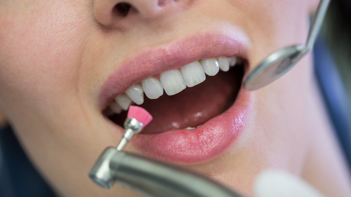 Pesquisadores britânicos desenvolveram um gel inovador capaz de regenerar o esmalte dentário e prevenir cáries de forma natural