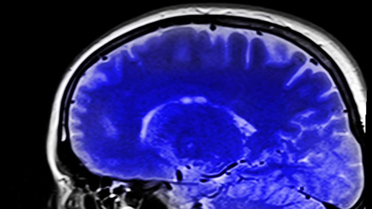 O remédio impede que o tumor cerebral sobreviva sem oxigênio. Imagem: Domínio público