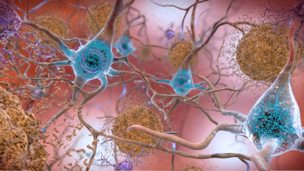 Acúmulo de placas beta-amiloide no cérebro são associadas com Mal de Alzheimer. Imagem: Domínio Público