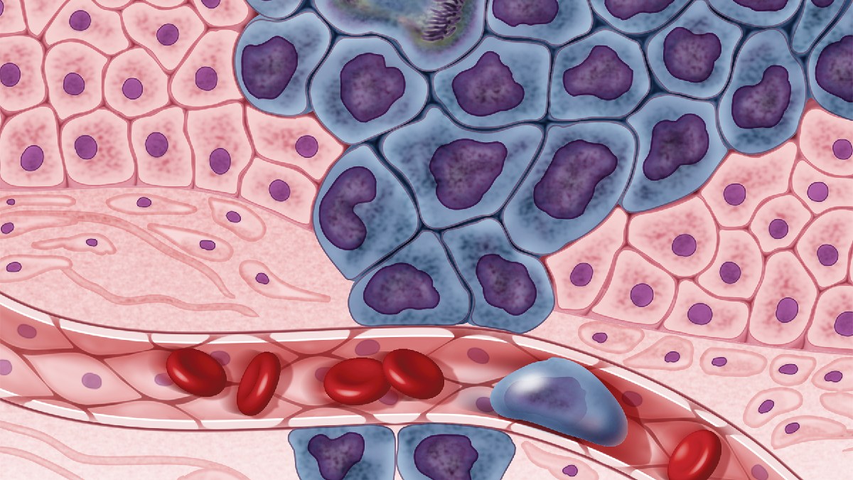 A jovem encontrou um tumor em estágio 3 no intestino grosso. Imagem: NIH Image Gallery/Flickr
