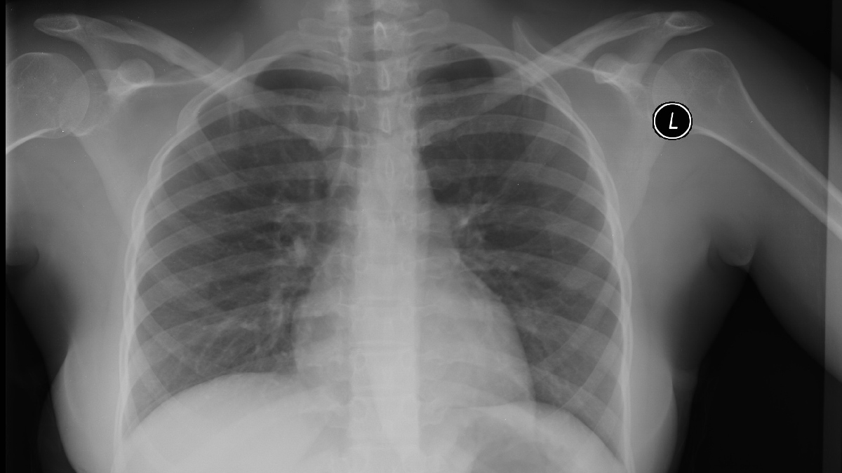 A densidade mineral óssea foi medida por meio do exame DXA, um tipo avançado de raio X utilizado no diagnóstico de osteoporose. Imagem: Dr. Yale Rosen Atlas of Pulmonary Pathology