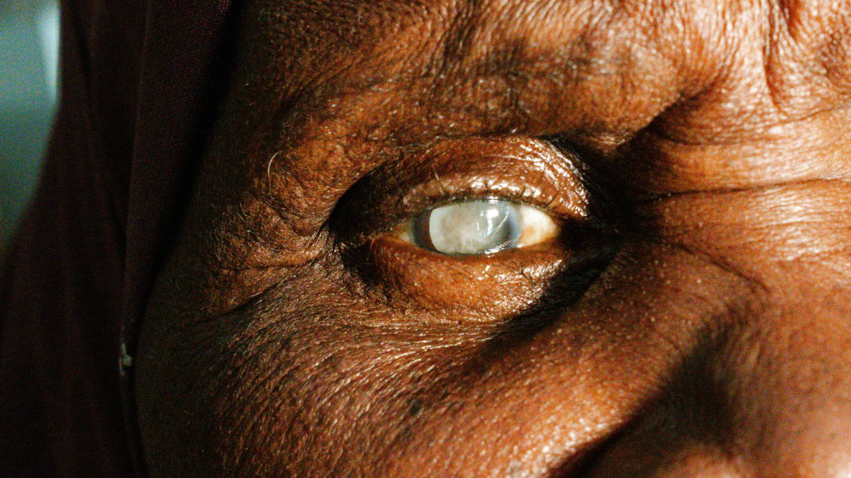 A catarata ocorre quando o cristalino, que funciona como uma lente natural nos olhos, começa a ficar opaco. Foto: Pexels