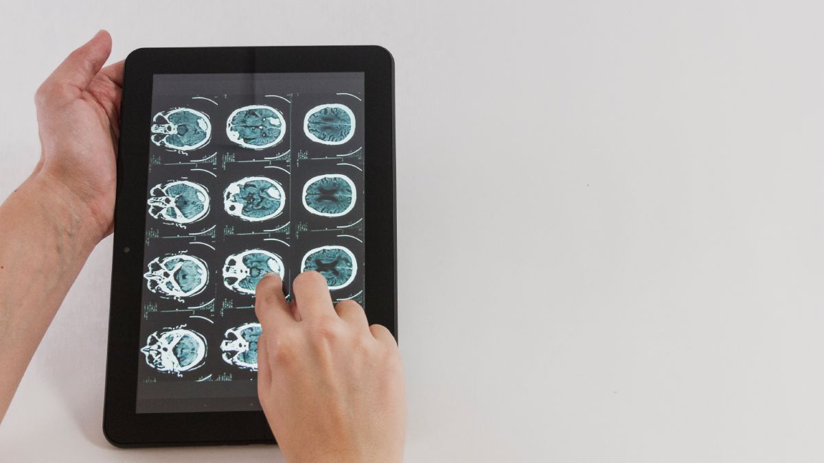 Surpreendentemente, os fatores de risco genético mais conhecidos para Alzheimer não explicam por completo esse padrão