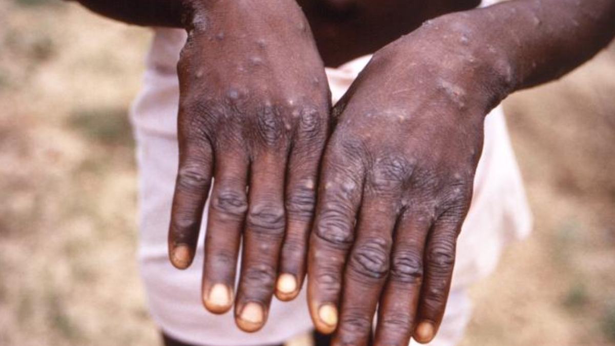 3) Mpox e contato íntimo: tocar na pele com feridas ou crostas pode facilitar o contágio, mesmo quando os sinais parecem discretos. Foto: Wikimedia Commons