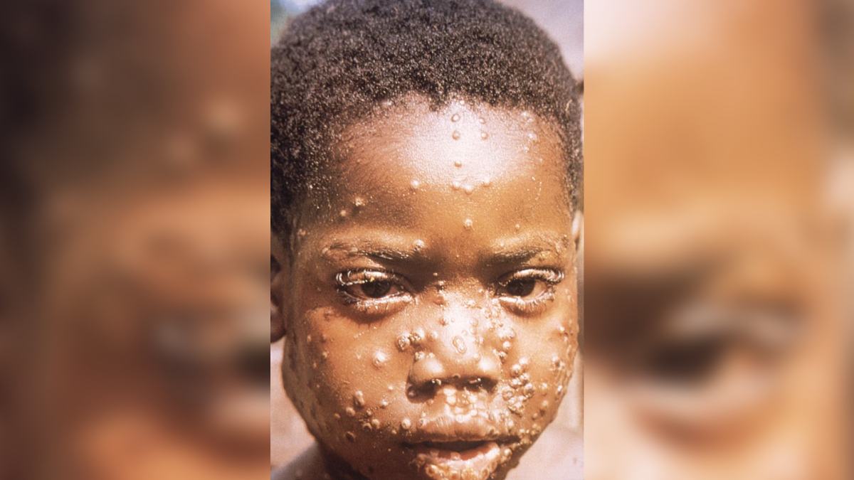 4) Toalhas e roupas de cama merecem cuidado: itens compartilhados podem virar ponte de transmissão quando há lesões ativas de mpox. Foto: Wikimedia Commons