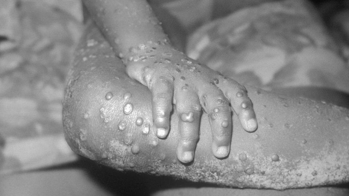 2) Abraço e beijo ficam no radar quando há sintomas: na mpox, o cuidado principal é evitar contato direto com lesões e secreções. Foto: Wikimedia Commons