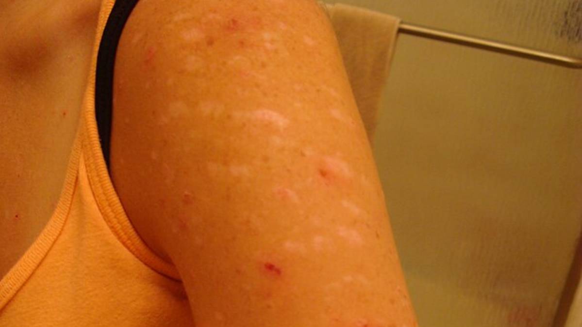 A dermatilomania, também chamada de transtorno de escoriação, é reconhecida pelo DSM-5 (Foto: Kairyu7/ Wikimedia Commons)