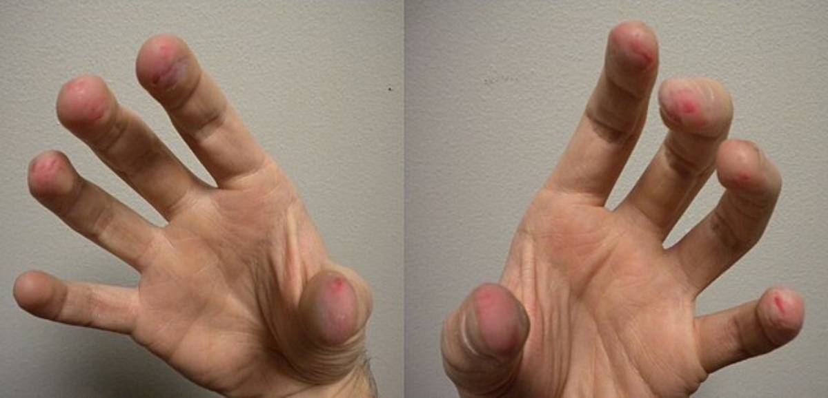 Assim, como um transtorno relacionado ao espectro do Transtorno Obsessivo-Compulsivo (TOC) (Foto: HyruleanHero1988/ Wikimedia Commons)