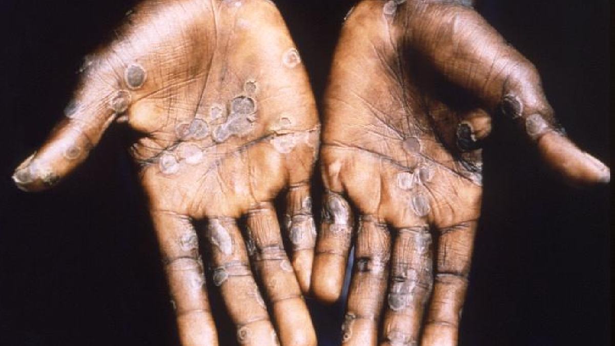 5) Lesões e crostas são um alerta: na mpox, cobrir feridas e evitar tocar nelas ajuda a reduzir a chance de espalhar o vírus. Foto: Wikimedia Commons