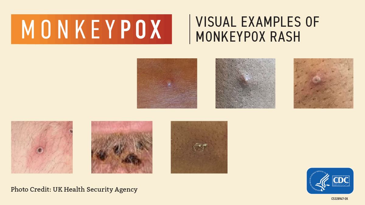 6) Vida em casa durante a mpox: separar objetos pessoais e higienizar superfícies é parte do pacote de prevenção quando há contato físico frequente. Foto: Wikimedia Commons