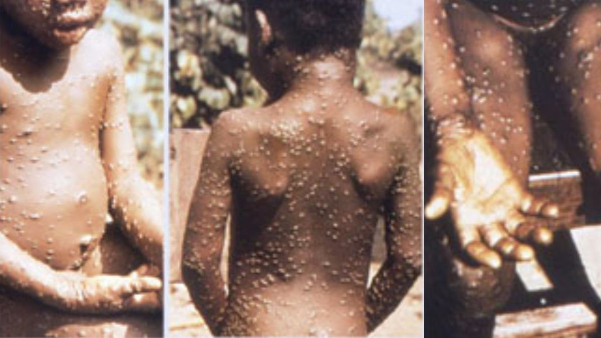 1) Contato físico próximo pede atenção: lesões na pele podem aumentar o risco de transmissão da mpox em situações do dia a dia. Foto: Wikimedia Commons