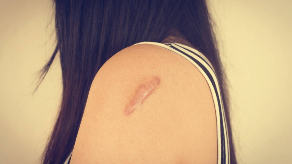 Limpeza adequada e proteção solar são medidas essenciais para reduzir o risco de marcas na pele. Foto: Freepik