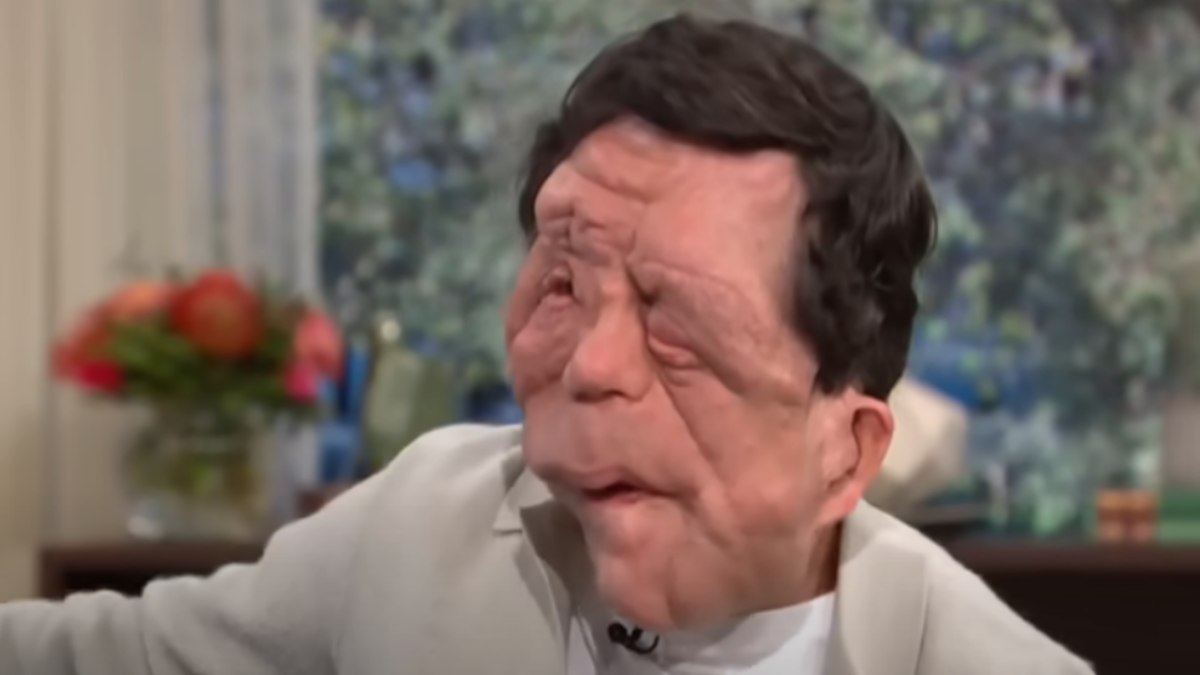A neurofibromatose é um grupo de doenças genéticas que afeta pele e sistema nervoso. Foto; Reprodução