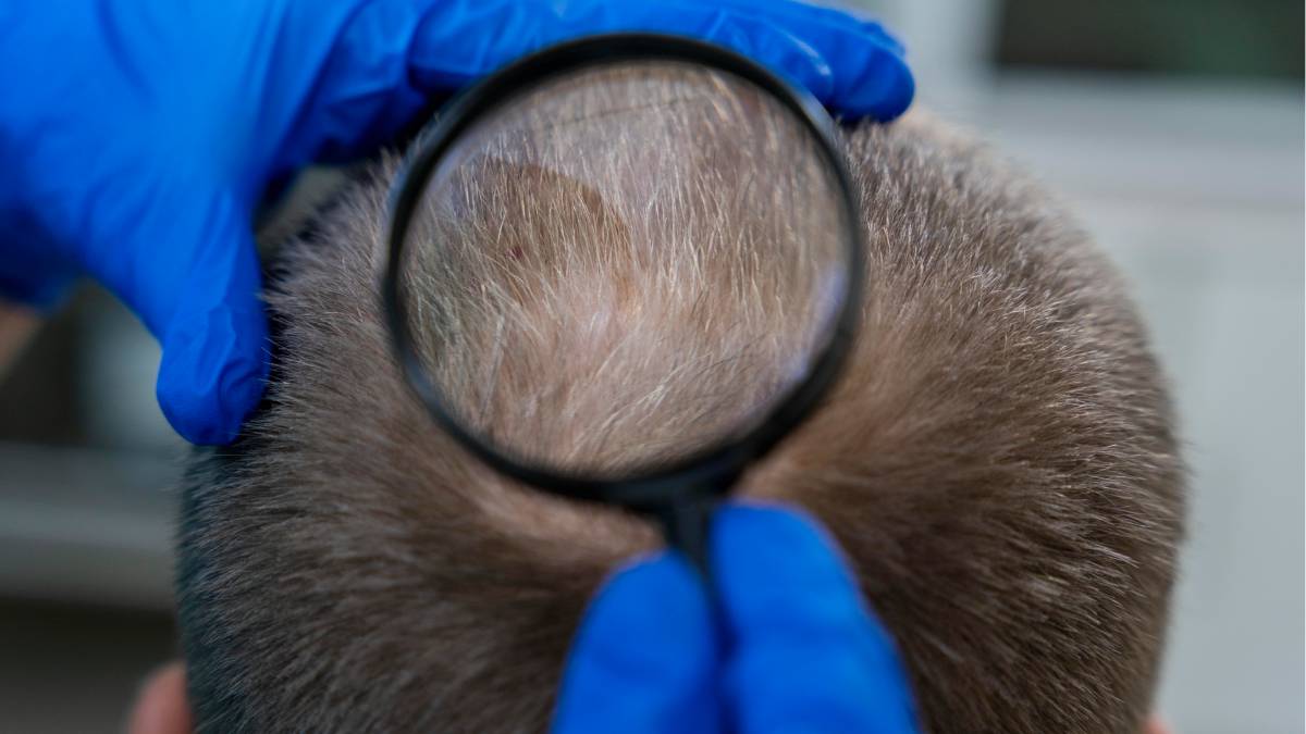 Há cerca de cinco séculos, manuais populares de medicina recomendavam lavar a cabeça com fezes humanas como forma de combater a calvície (Fotos: Freepik)