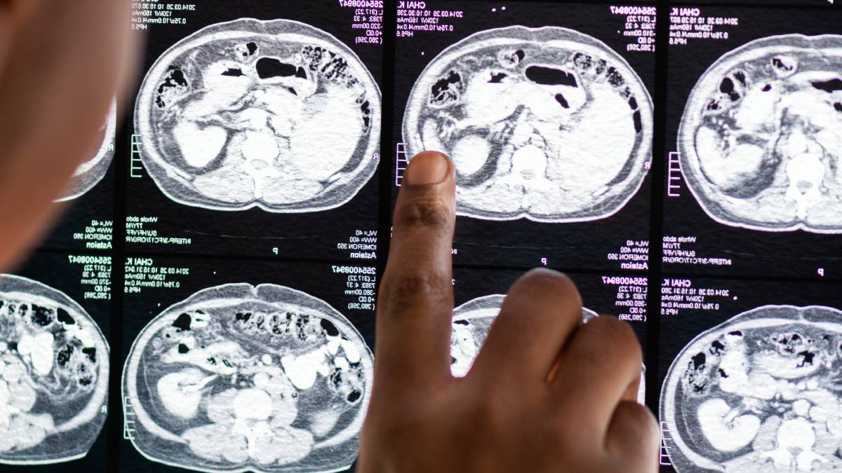 Informação e diagnóstico precoce podem fazer diferença em casos de aneurisma cerebral. Foto: Freepik