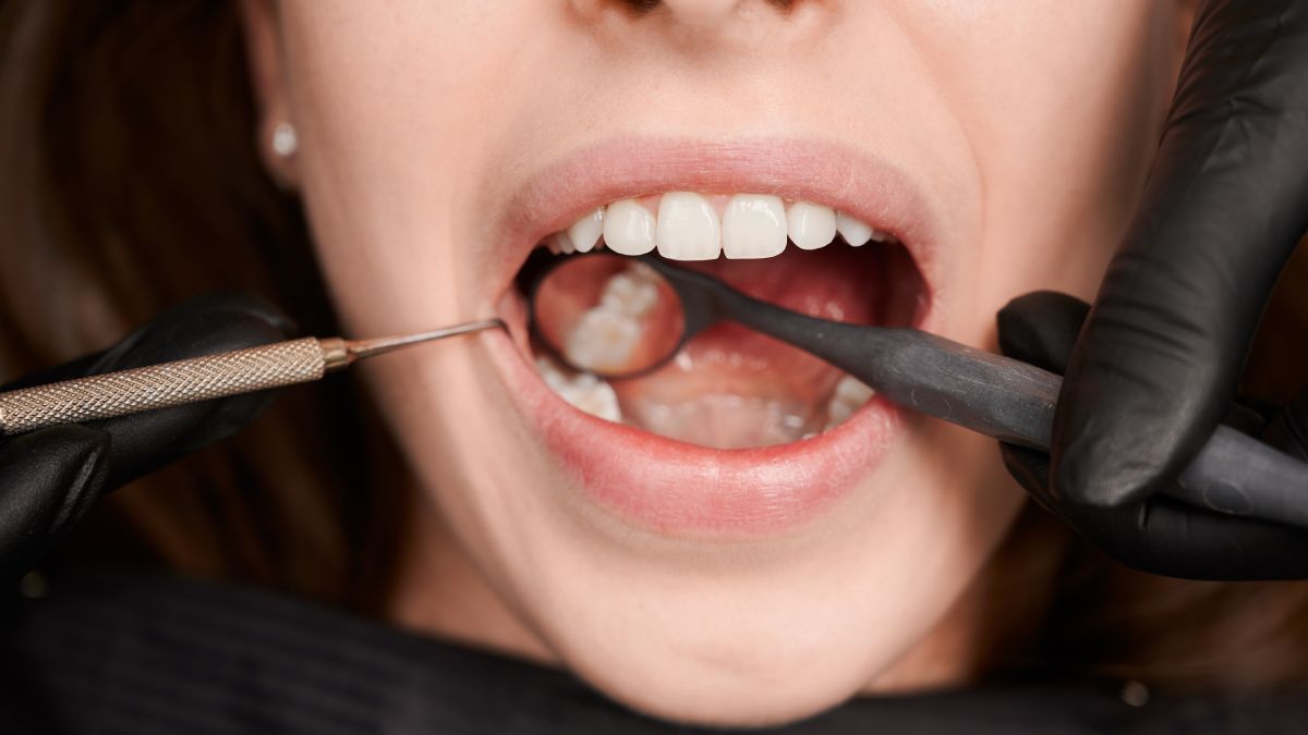 O cálculo dental se forma quando a placa bacteriana se mineraliza, criando uma camada rígida que preserva microrganismos, proteínas e DNA (Foto: Freepik)