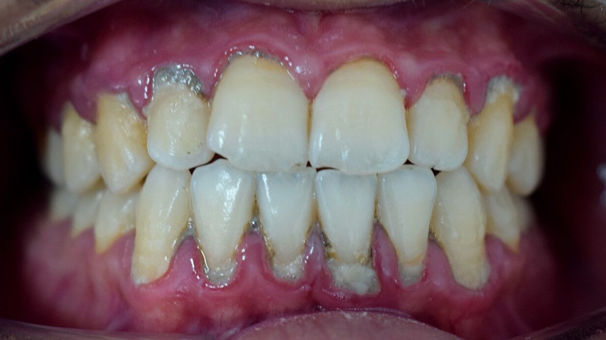 O tártaro protege tanto o DNA bacteriano quanto o do próprio hospedeiro, oferecendo uma visão detalhada da microbiota oral ao longo da história (Foto: Shaimaa Abdellatif/Wikimedia Commons)