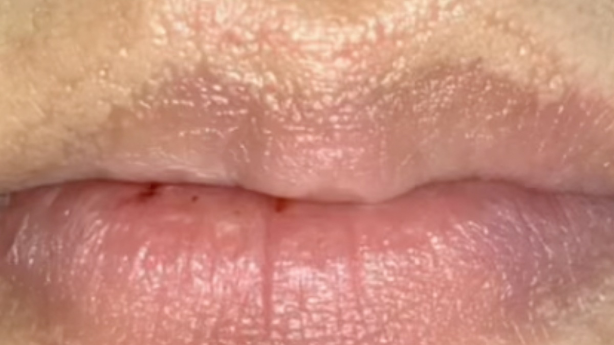 A condição não é contagiosa e não tem relação com herpes, HPV ou outras doenças. Foto: Reprodução/YT