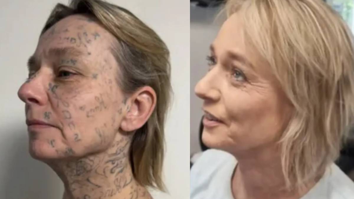 Veja o antes e depois após a remoção das tatuagens