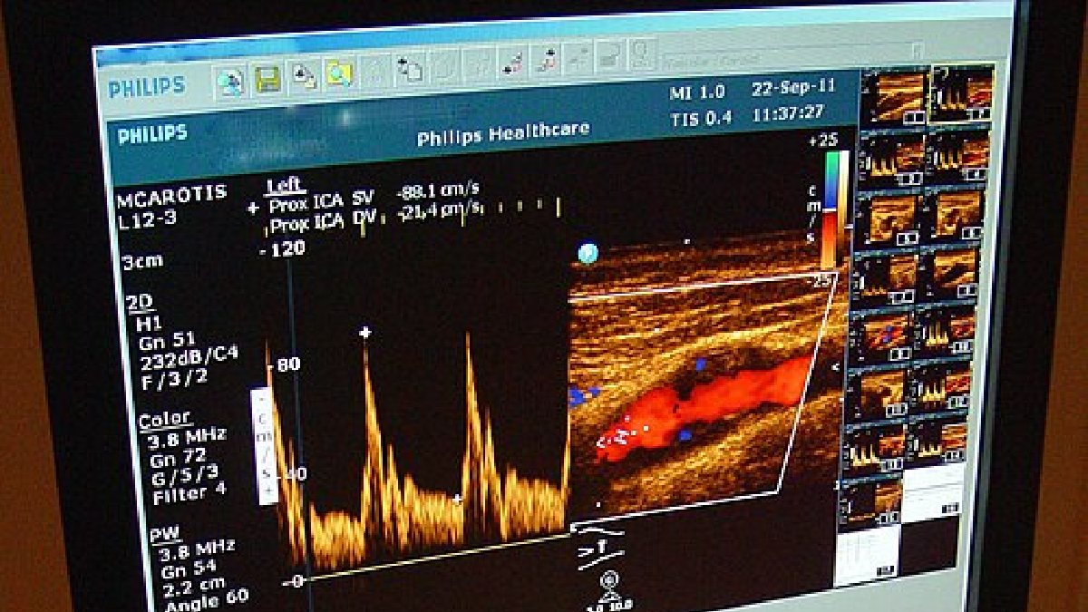 O Doppler das carótidas avalia o fluxo nas artérias que levam sangue ao cérebro e pode fazer parte da investigação vascular após um AVC (Foto: Etan J. Tal / Wikimedia Commons)
