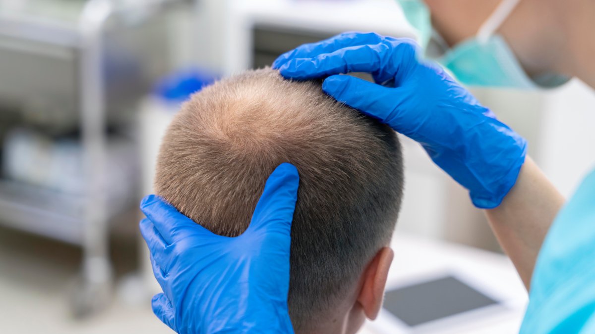 Ter mais cabelo pode ser um efeito colateral de genes que trazem outras vantagens à nossa saúde