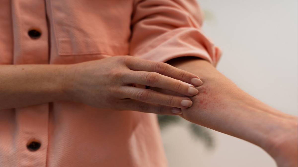 Existe uma condição pouco conhecida chamada Fotodermatose inflamatória persistente