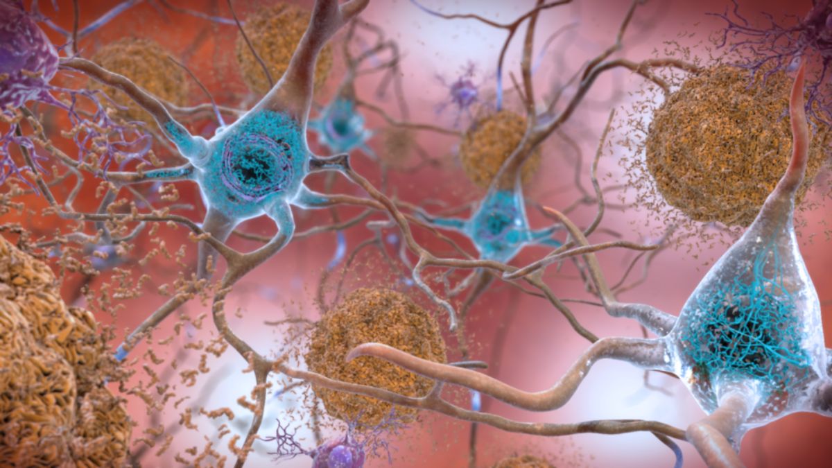O Alzheimer afeta regiões ligadas à memória e ainda desafia pesquisadores em todo o mundo (Foto: Wikimedia Commnons/ NIH Image Gallery)