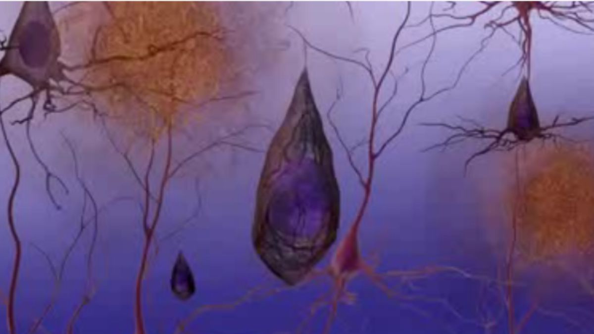 Proteínas associadas ao Alzheimer ajudam cientistas a mapear os caminhos da doença no cérebro (Foto: Wikimedia Commons/National Institute on Aging)