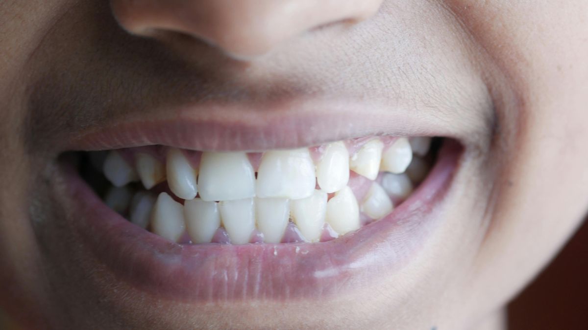 Pontes dentárias modernas têm aparência muito diferente, mas respondem a uma preocupação antiga: recuperar função e aparência (Foto: Pexels)